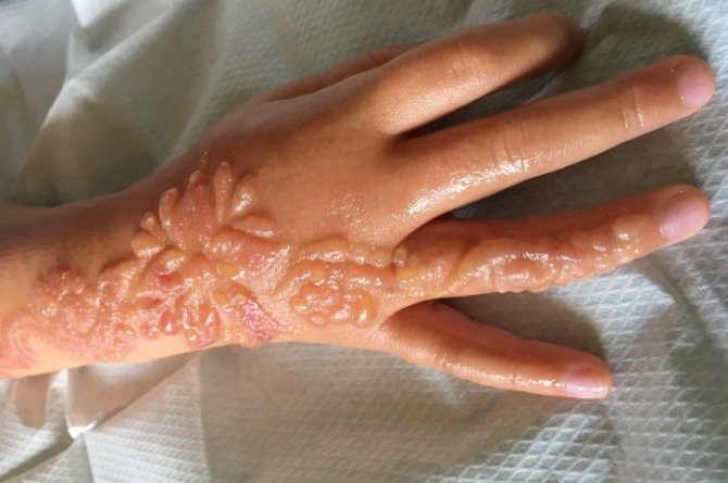 black henna tattoo risks