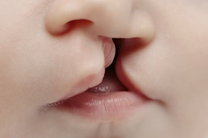 breastfeeding babies with cleft lip